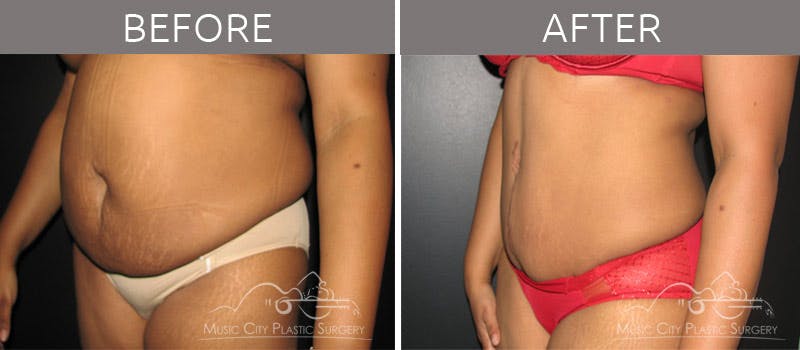 Abdominoplasty Before & After Gallery - Patient 90704949 - Image 3