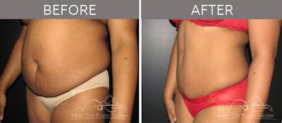 Abdominoplasty Before & After Gallery - Patient 90704949 - Image 2