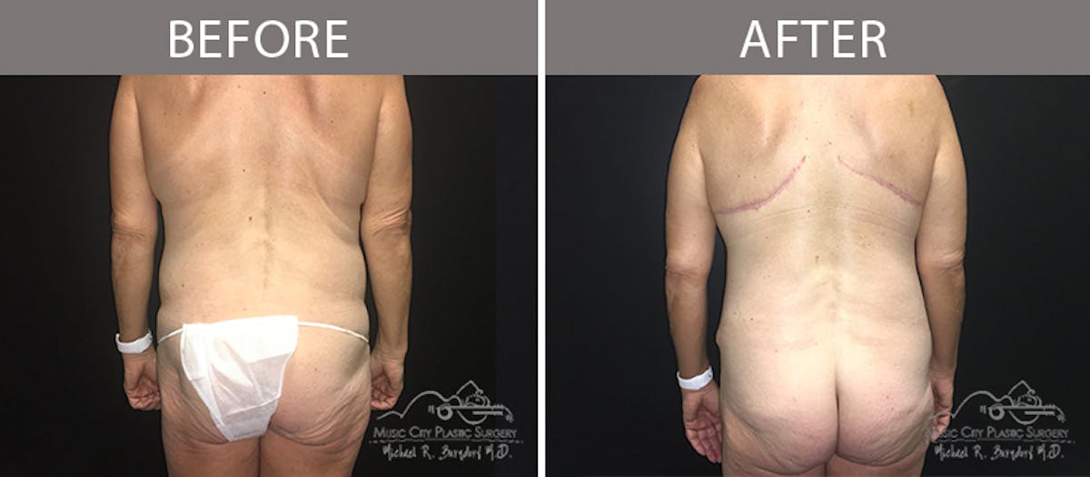 Bra Strap Excision Before & After Gallery - Patient 90704953 - Image 4