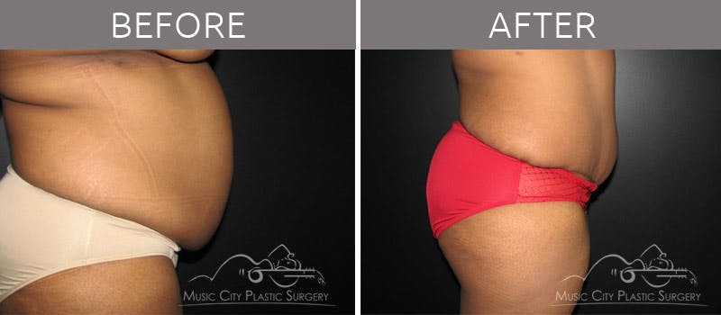 Abdominoplasty Before & After Gallery - Patient 90704949 - Image 4