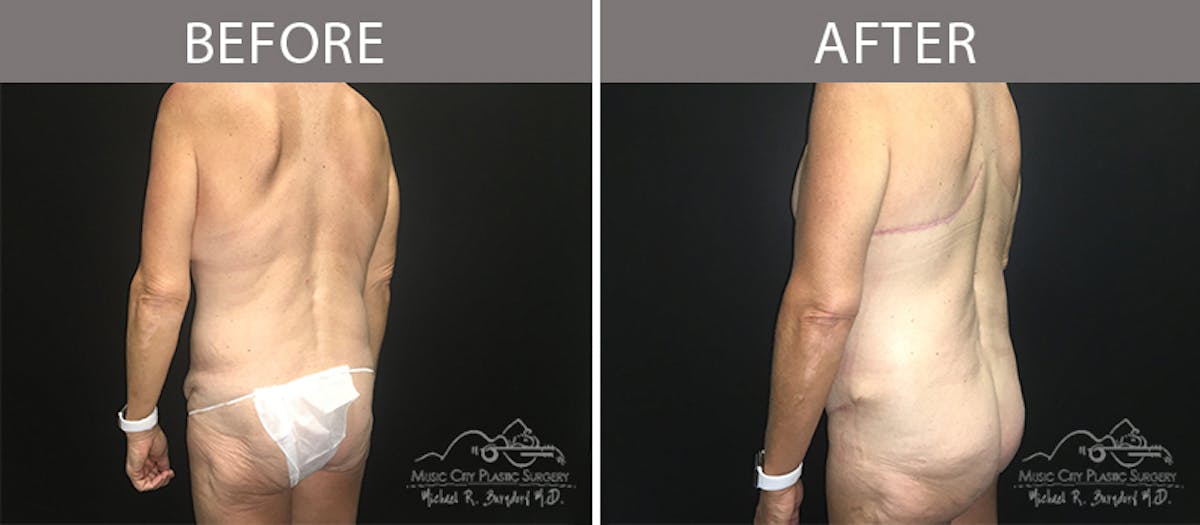 Bra Strap Excision Before & After Gallery - Patient 90704953 - Image 5