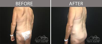 Bra Strap Excision Before & After Gallery - Patient 90704953 - Image 3