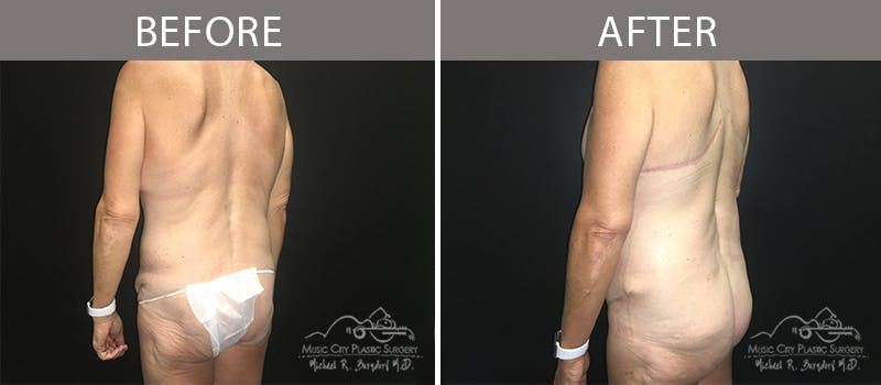 Bra Strap Excision Before & After Gallery - Patient 90704953 - Image 3