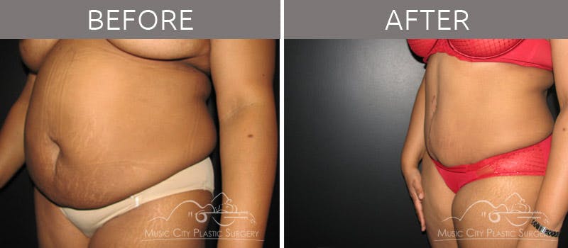 Abdominoplasty Before & After Gallery - Patient 90704949 - Image 5