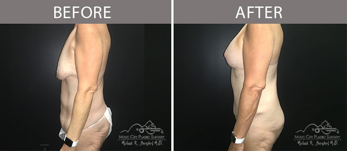 Bra Strap Excision Before & After Gallery - Patient 90704953 - Image 3