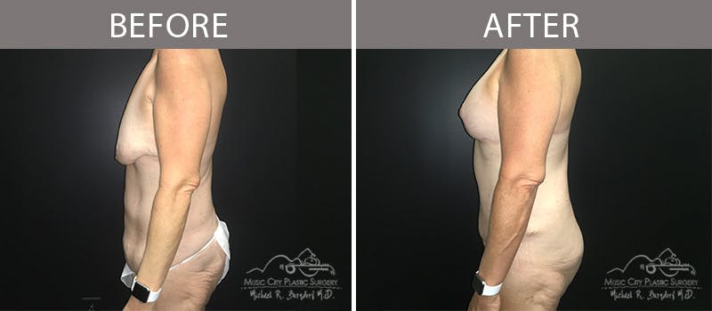 Bra Strap Excision Before & After Gallery - Patient 90704953 - Image 4