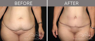 Abdominoplasty Before & After Gallery - Patient 90704952 - Image 1