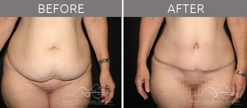 Abdominoplasty Before & After Gallery - Patient 90704952 - Image 1