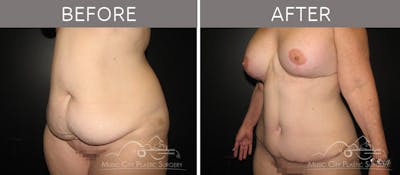 Abdominoplasty Before & After Gallery - Patient 90704952 - Image 2