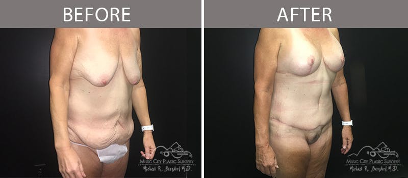 Bra Strap Excision Before & After Gallery - Patient 90704953 - Image 6