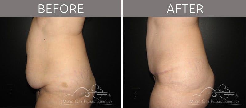 Abdominoplasty Before & After Gallery - Patient 90704952 - Image 3