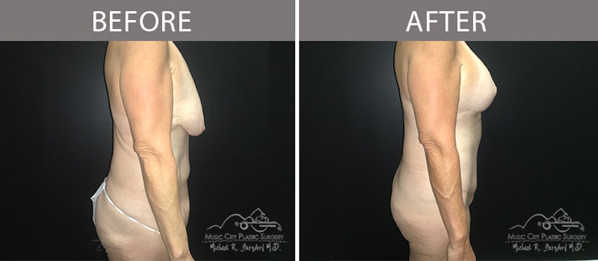 Bra Strap Excision Before & After Gallery - Patient 90704953 - Image 7
