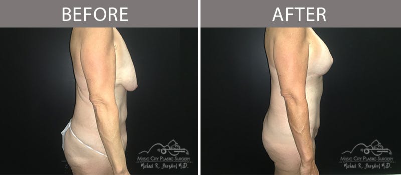 Bra Strap Excision Before & After Gallery - Patient 90704953 - Image 7