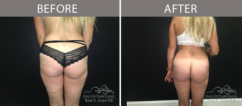 Brazilian Butt Lift Before & After Gallery - Patient 90704957 - Image 1
