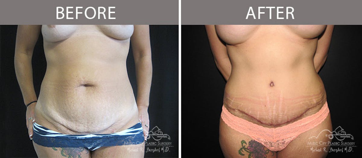 Abdominoplasty Before & After Gallery - Patient 90704956 - Image 1