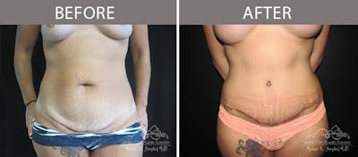 Abdominoplasty Before & After Gallery - Patient 90704956 - Image 1