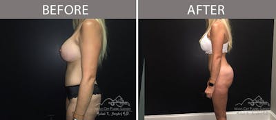 Brazilian Butt Lift Before & After Gallery - Patient 90704957 - Image 2