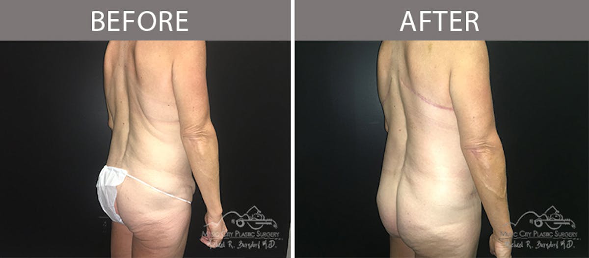 Bra Strap Excision Before & After Gallery - Patient 90704953 - Image 8
