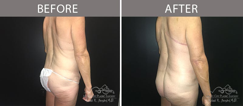 Bra Strap Excision Before & After Gallery - Patient 90704953 - Image 8