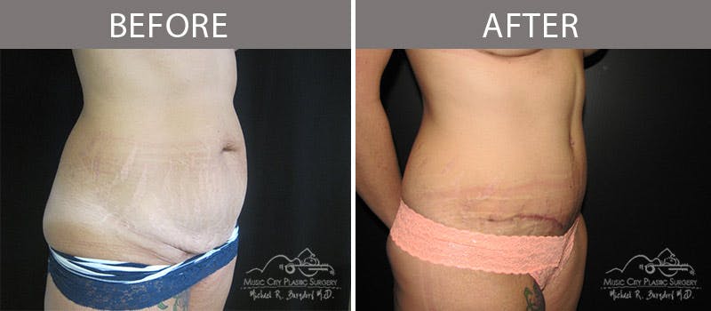 Abdominoplasty Before & After Gallery - Patient 90704956 - Image 2
