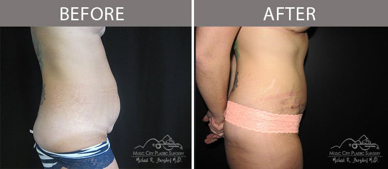 Abdominoplasty Before & After Gallery - Patient 90704956 - Image 3