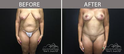 Abdominoplasty Before & After Gallery - Patient 90704965 - Image 1