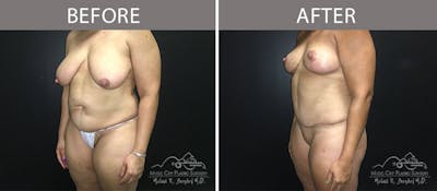 Abdominoplasty Before & After Gallery - Patient 90704965 - Image 2