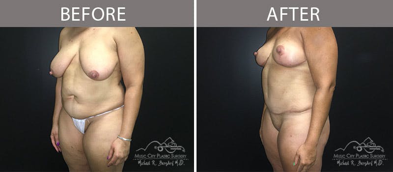 Abdominoplasty Before & After Gallery - Patient 90704965 - Image 2