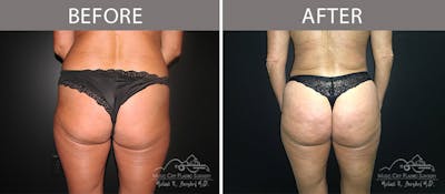 Brazilian Butt Lift Before & After Gallery - Patient 90704964 - Image 1