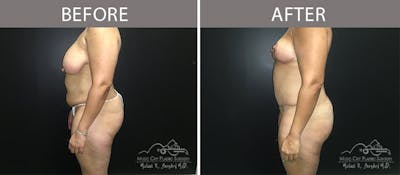 Abdominoplasty Before & After Gallery - Patient 90704965 - Image 3