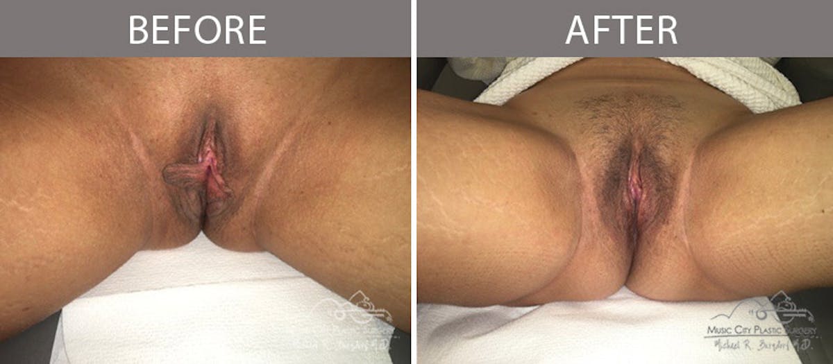 Labiaplasty Before & After Gallery - Patient 90704963 - Image 1