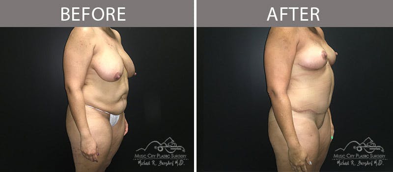 Abdominoplasty Before & After Gallery - Patient 90704965 - Image 4