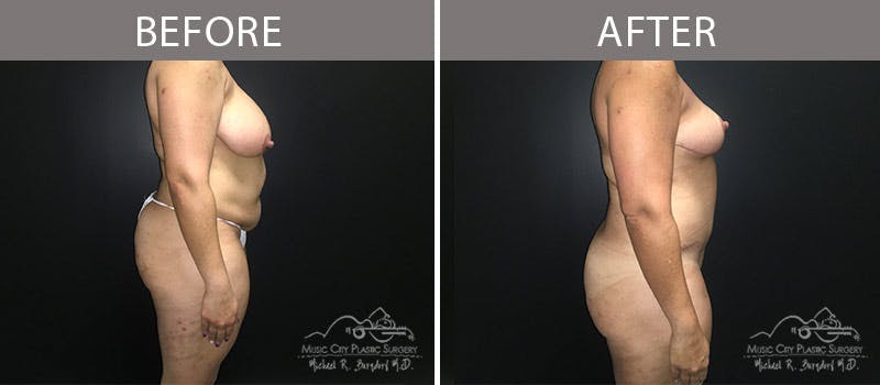 Abdominoplasty Before & After Gallery - Patient 90704965 - Image 5