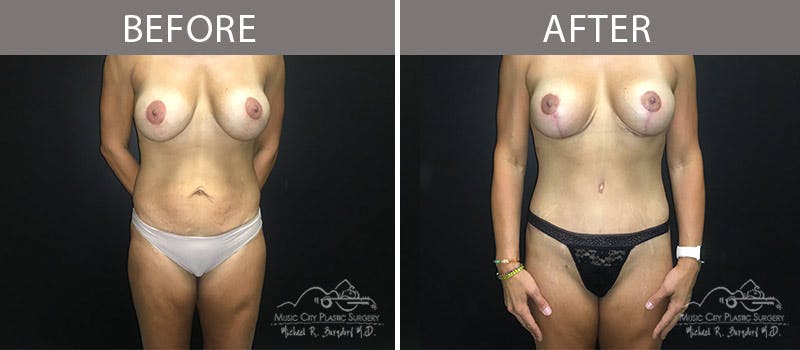 Abdominoplasty Before & After Gallery - Patient 90704978 - Image 1