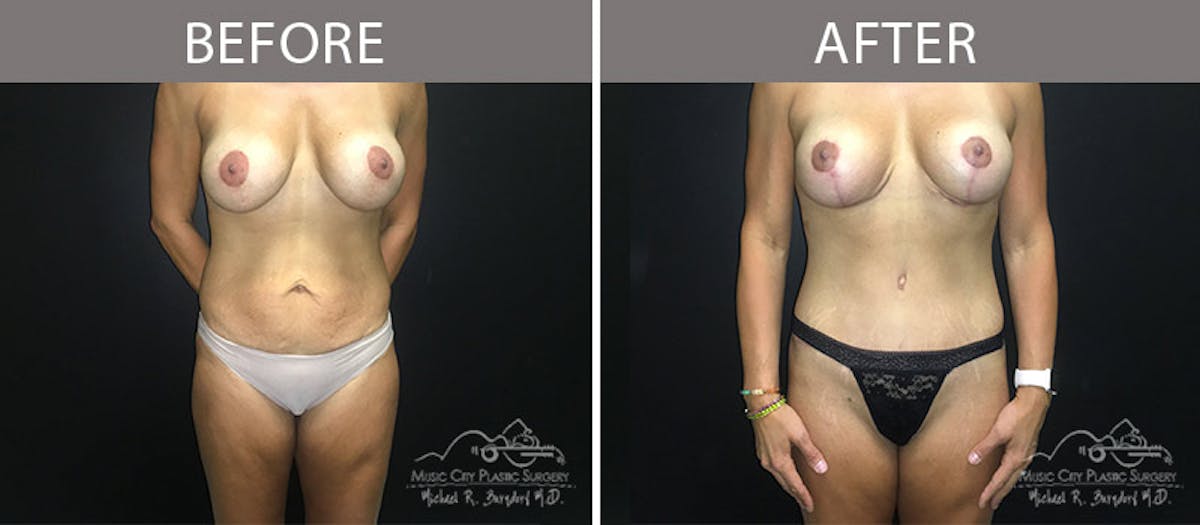 Abdominoplasty Before & After Gallery - Patient 90704978 - Image 1