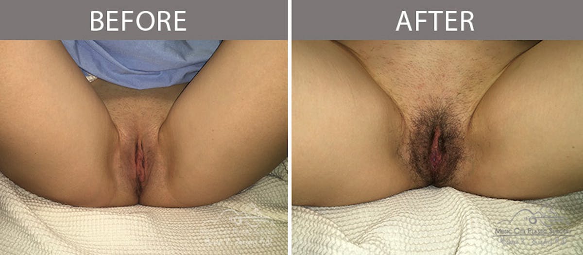Labiaplasty Before & After Gallery - Patient 90704976 - Image 1