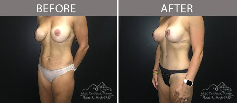 Abdominoplasty Before & After Gallery - Patient 90704978 - Image 2