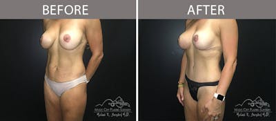 Abdominoplasty Before & After Gallery - Patient 90704978 - Image 2