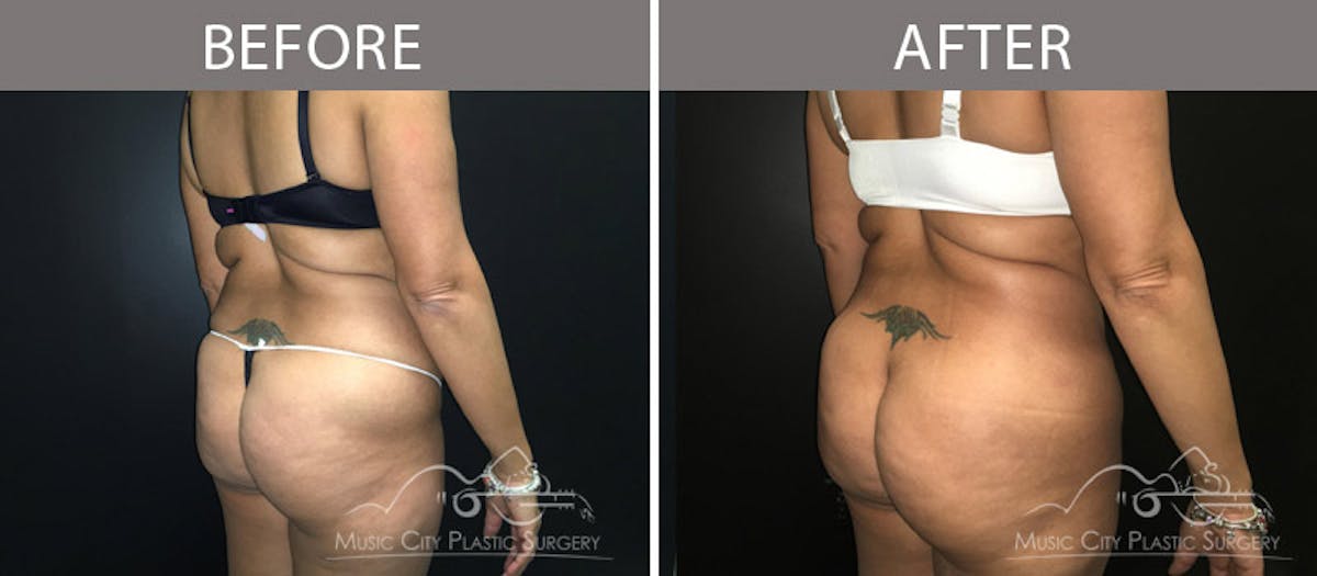 Brazilian Butt Lift Before & After Gallery - Patient 90704968 - Image 3