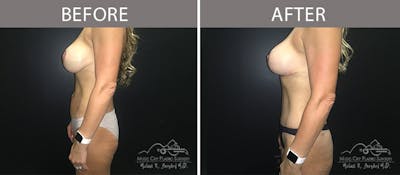 Abdominoplasty Before & After Gallery - Patient 90704978 - Image 3