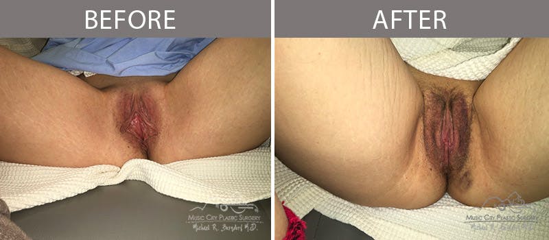 Labiaplasty Before & After Gallery - Patient 90704975 - Image 1