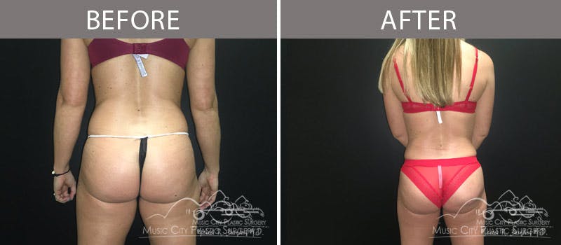 Brazilian Butt Lift Before & After Gallery - Patient 90704977 - Image 1