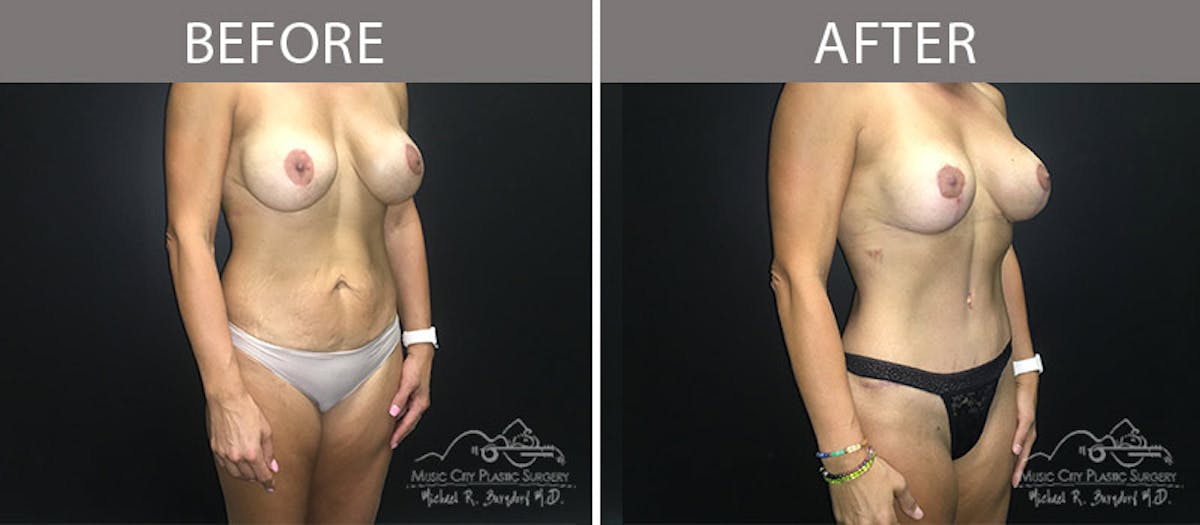 Abdominoplasty Before & After Gallery - Patient 90704978 - Image 4