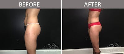 Brazilian Butt Lift Before & After Gallery - Patient 90704977 - Image 2