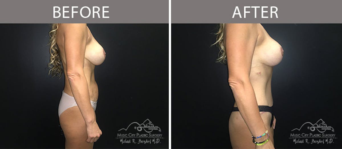 Abdominoplasty Before & After Gallery - Patient 90704978 - Image 5