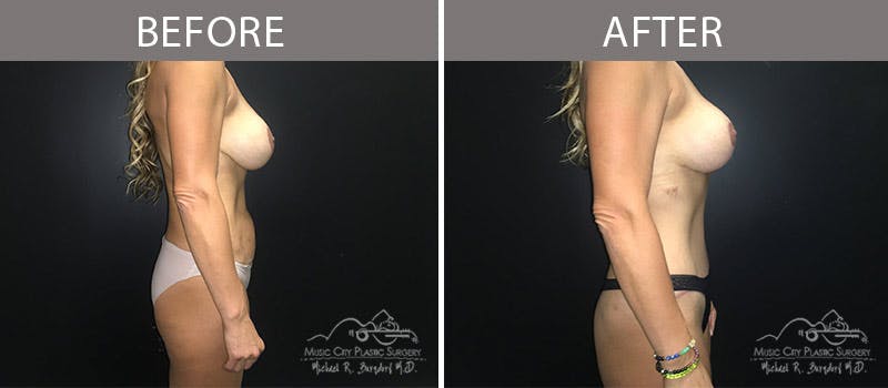 Abdominoplasty Before & After Gallery - Patient 90704978 - Image 5
