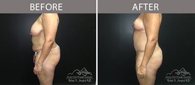 Liposuction Before & After Gallery - Patient 90704987 - Image 3