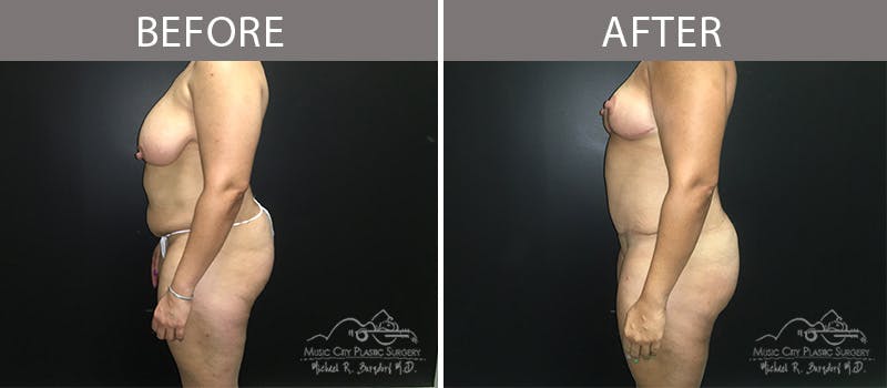 Liposuction Before & After Gallery - Patient 90704987 - Image 1