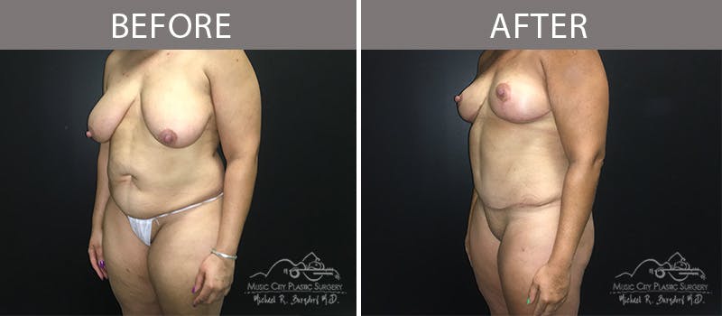 Liposuction Before & After Gallery - Patient 90704987 - Image 2