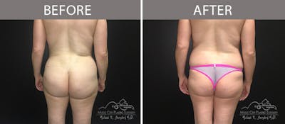 Brazilian Butt Lift Before & After Gallery - Patient 90704986 - Image 1